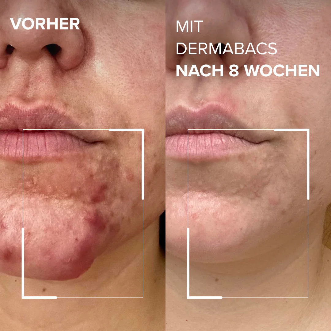 DermabacsÂź